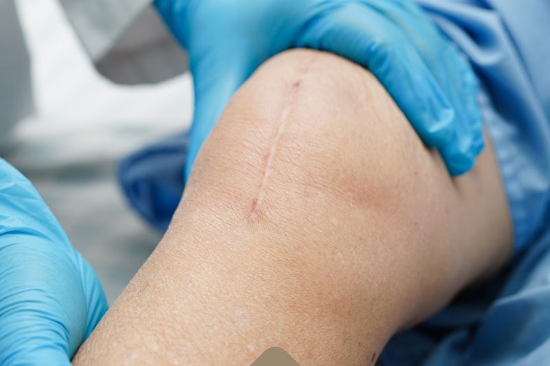 Harnessing the Power of Exosomes and Platelet-Rich Plasma (PRP) for Wound Healing at Zinnia Aesthetics and Anti-Aging Clinic