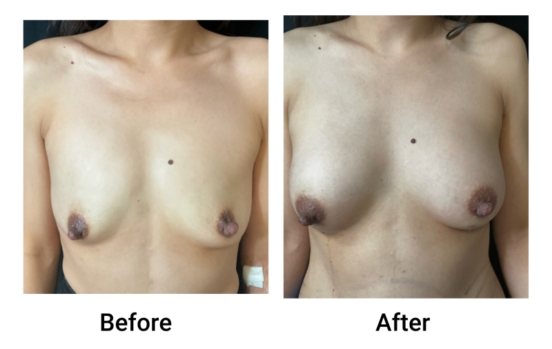 DMV Fat Transfer to the Breast