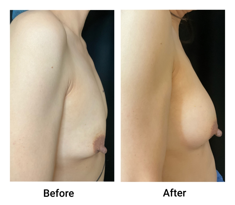 DMV Fat Transfer to the Breast