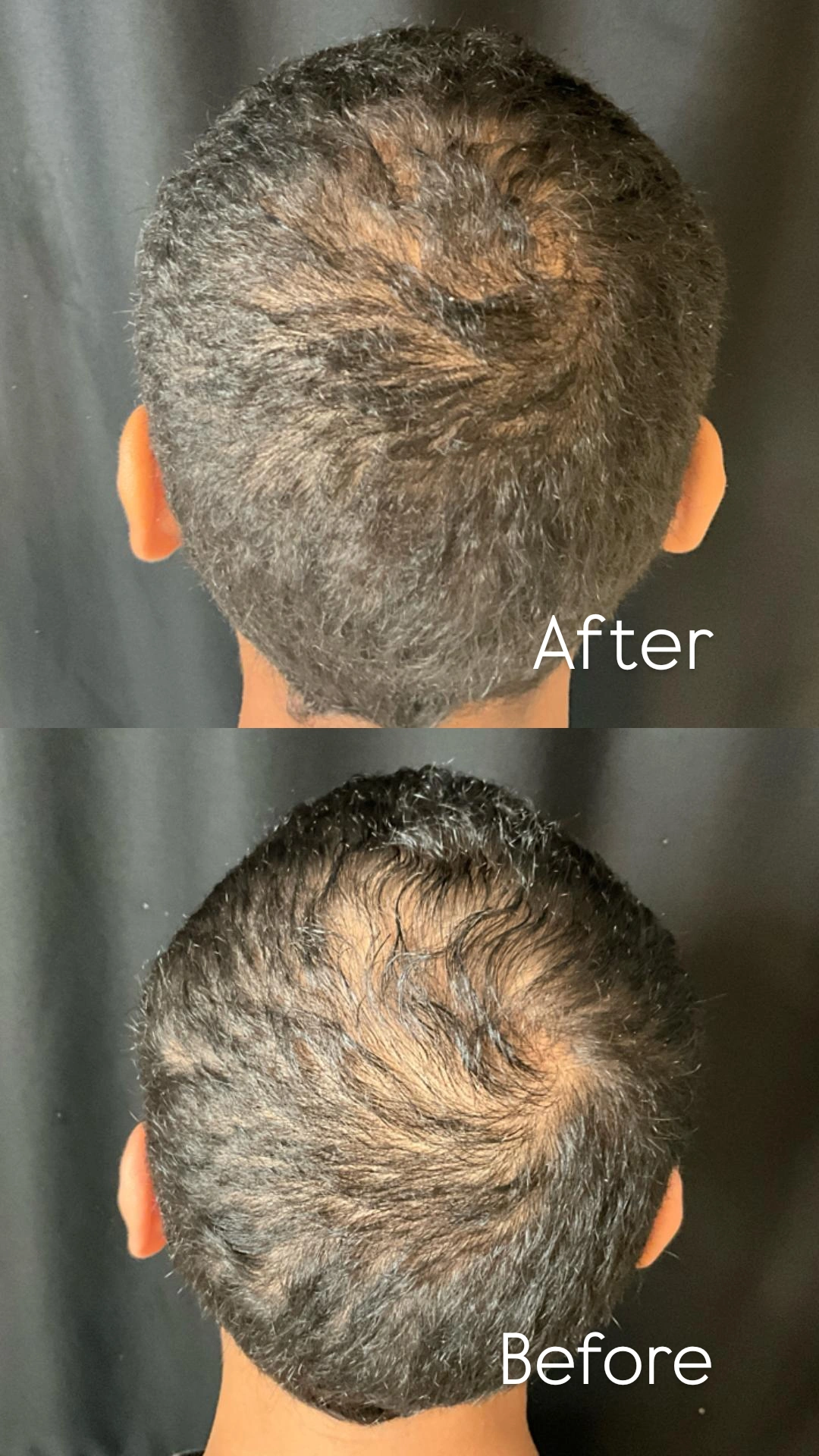 DMV PRP for Treatment of Hair Loss