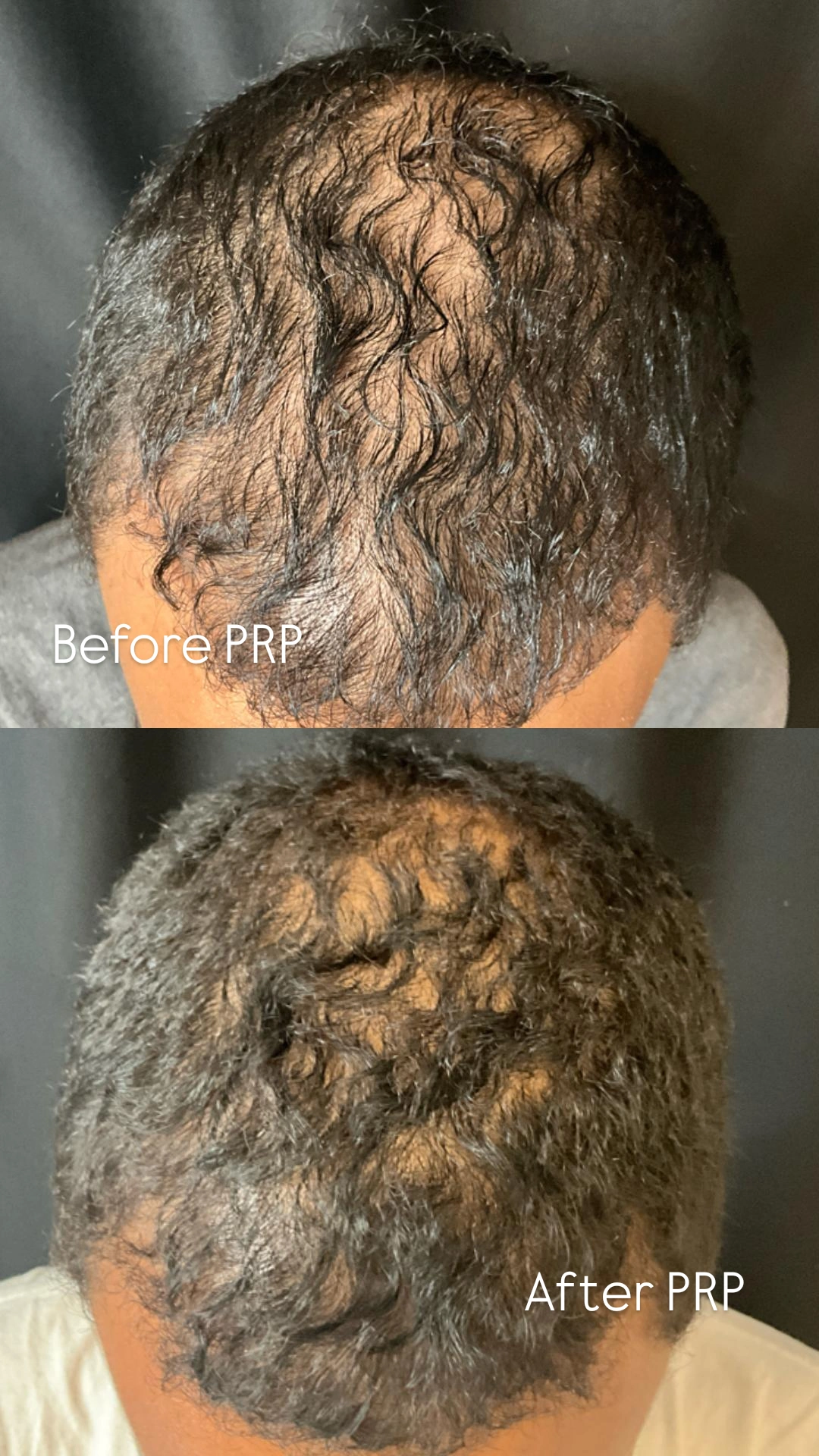 DMV PRP for Treatment of Hair Loss