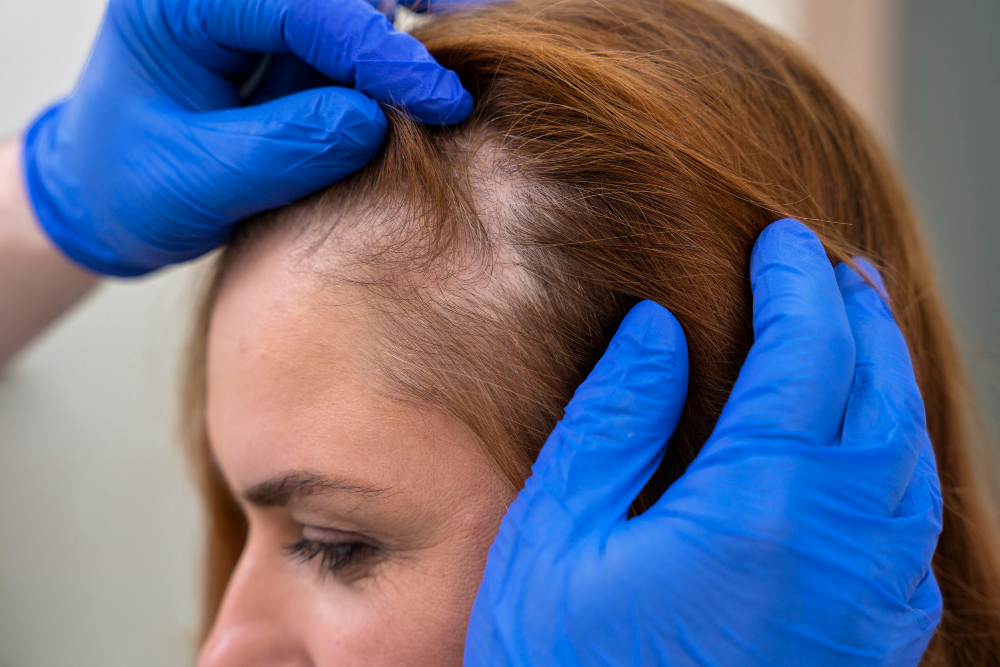 Exosomes for Hair Restoration