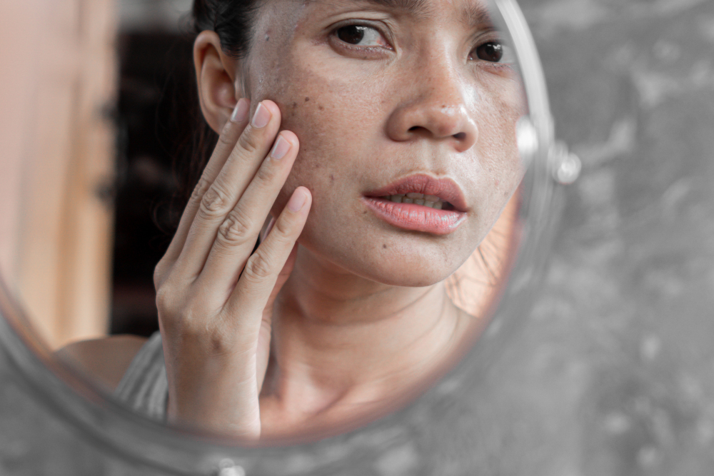 DMV Skin Treatments: Acne, Rosacea And Melasma Specialist
